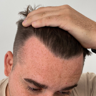 Hair Restoration With DHI Technique in Dubai