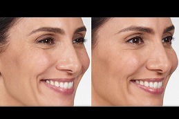 How Long Do Botox Injections Last For Wrinkles Clinic in Abu Dhabi