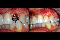 How Long Do Implant Teeth Last Clinic in Abu Dhabi