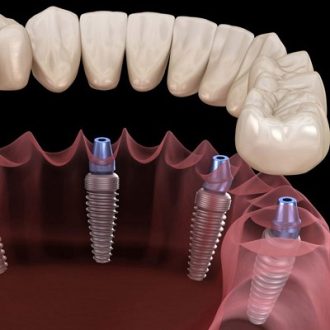How Long Do Implant Teeth Last in Dubai?