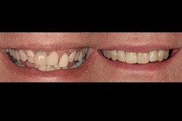 How Long Do Implant Teeth Last in Dubai