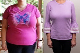 How Long Does Gastric Plication Last Clinic in Abu Dhabi