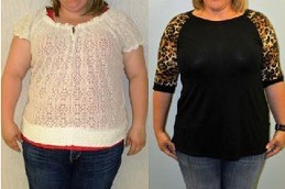 How Long Does Gastric Plication Last in Dubai