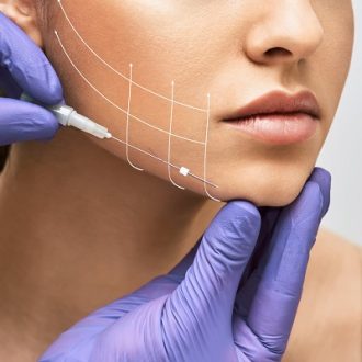 How Long Does Silhouette Soft Thread Lift In Dubai?