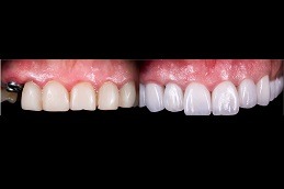How Many Teeth Can an Implant Hold Clinic in Abu Dhabi
