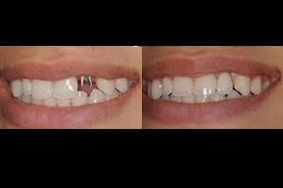 How Many Teeth Can an Implant Hold in Dubai