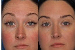 Is Botox Painful Clinic in Abu Dhabi
