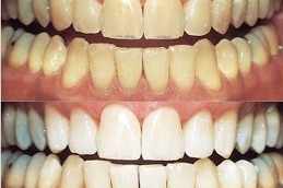 Is Dental Whitening Worth It in Dubai