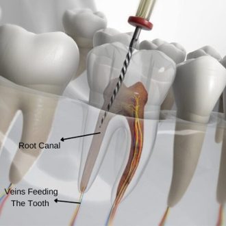 Is It Possible To Save All Teeth By Performing A Root Canal Treatment?
