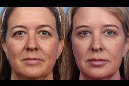 Liquid FaceLift Procedure, Cost and Risks in Dubai