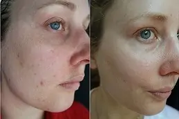 Microneedling for Hyperpigmentation Can it Help Clinic in Abu Dhabi