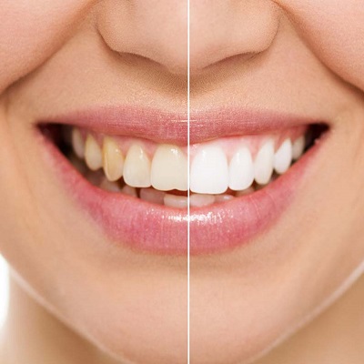 Teeth Whitening Vs Teeth Cleaning in Dubai & Abu Dhabi Cost