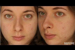 The Dos and Don'ts of Salicylic Acid Peeling in Dubai