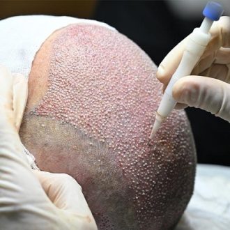 What Do You Need To Know About Direct Hair Implantation?