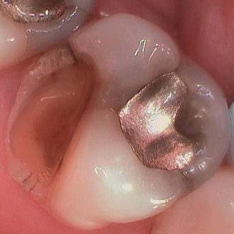 What Kind Of Tooth Pain Requires A Root Canal?