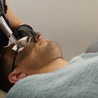 Which Is Better Carbon Laser Or Chemical Peel?