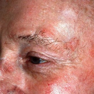 Actinic Keratosis: Treatment Options in Dubai