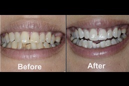 Are There Any Maintenance Tips for Teeth Whitening Clinic in Abu Dhabi