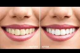 Are There Any Maintenance Tips for Teeth Whitening in Dubai