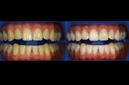 Best Are There Any Maintenance Tips for Teeth Whitening in Dubai