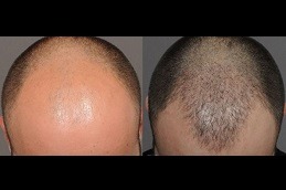 Best FUE Hair Transplant What Is It in Dubai