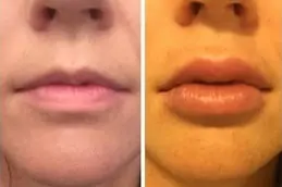 Best How Long Does Lip Reduction Last in Dubai