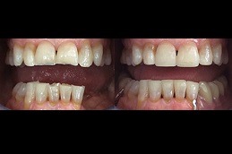 Best How to Treat a Toothache in Dubai