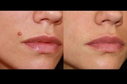 Best Mole Removal - What To Expect During And After The Procedure in Dubai