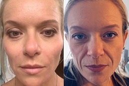 Best The Vampire Facial Treatment Process Explained in Dubai