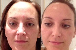 Best What Does Red Led Light Do For The Skin in Dubai