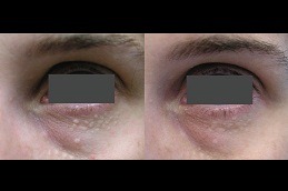 Best What Is The Best Way To Treat Syringoma in Dubai