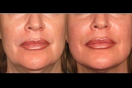 Best What Treatments Do Celebrities Use For Skin Tightening in Dubai