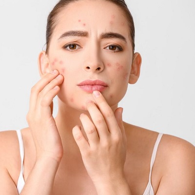 Chemical Peels For Acne Scars: Pros And Cons
