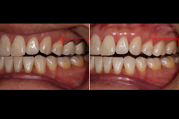 Do Teeth Look Better After Cleaning Clinic in Abu Dhabi