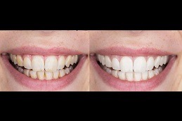 Do Teeth Look Better After Cleaning in Dubai