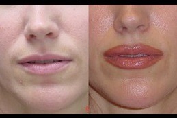 How Long Does Lip Reduction Last Clinic in Abu Dhabi