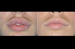 How Long Does Lip Reduction Last in Dubai