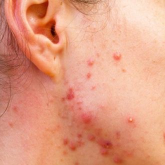 How Long Does Skin Lesion Removal Take in Dubai?