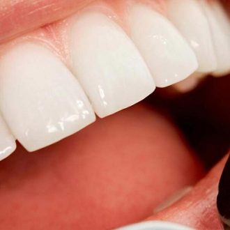 How Long is the Hollywood Smile Procedure?