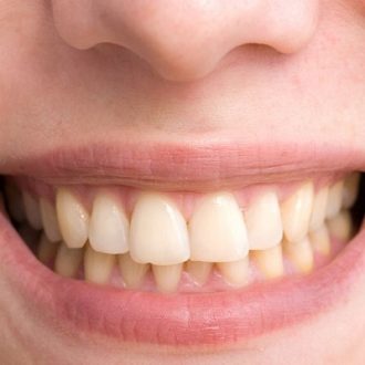 How Much Does It Cost To Clean Yellow Teeth?