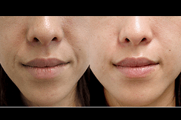 Hyaluronic Acid Serum For Skin Clinic in Abu Dhabi