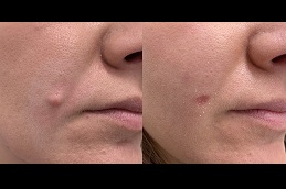 Mole Removal - What To Expect During And After The Procedure Clinic in Abu Dhabi