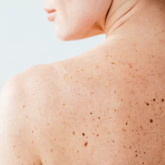 Mole Removal: What To Expect During And After The Procedure?