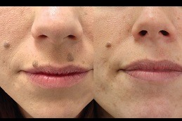 Mole Removal - What To Expect During And After The Procedure in Dubai