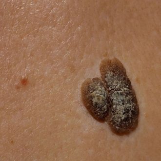 Surgical Options for Seborrheic Keratosis in Dubai