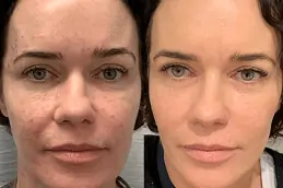 The Vampire Facial Treatment Process Explained Clinic in Abu Dhabi