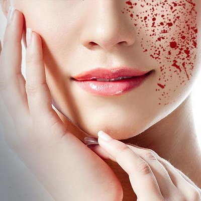 The Vampire Facial Treatment Process Explained