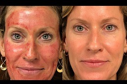 The Vampire Facial Treatment Process Explained in Dubai