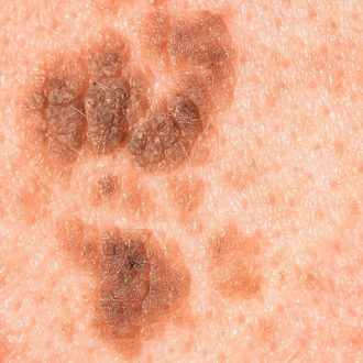 Understanding Seborrheic Keratosis And Treatment Options