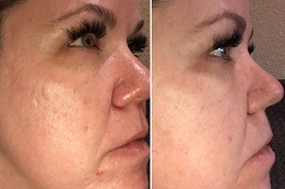 What Does Red Led Light Do For The Skin in Dubai